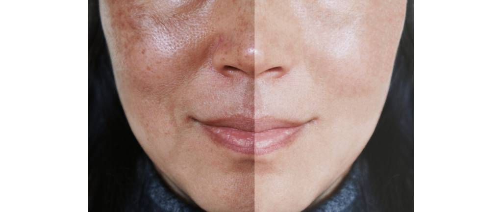 face feminina demonstrando um lado com melasma e outro sem melasma