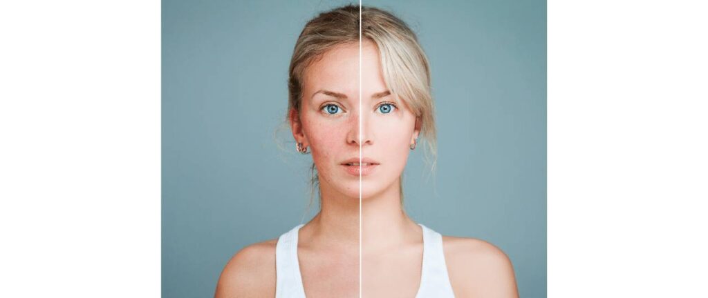 Mulher com um lado rosto com acne e outro lado do rosto sem acne